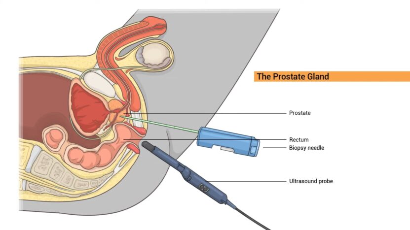 prostate cancer diagnosis methods